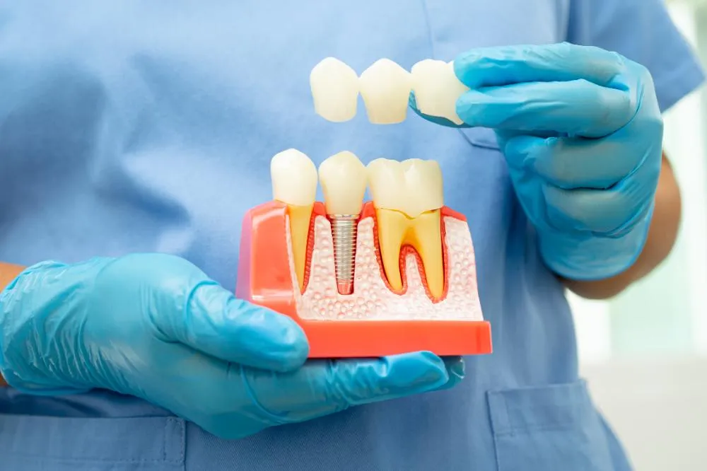 model of dental implant of artificial teeth