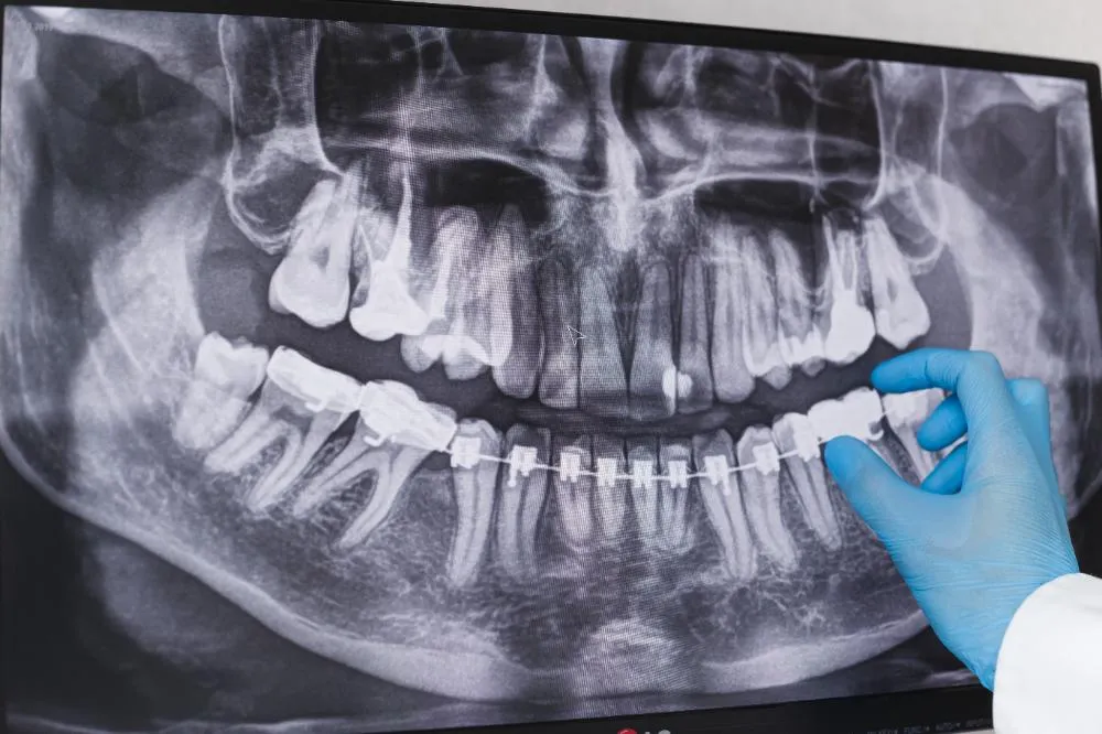 doctor pointing to braces in a dental xray