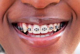 Braces and orthodontics treatment at Garden Family Dental Centre
