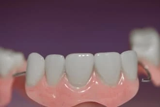 Crowns and bridges treatment at Garden Family Dental Centre