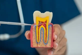 Root canal treatment at Garden Family Dental Centre