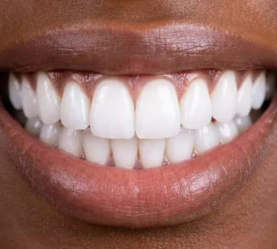 Teeth after whitening treatment at Garden Family Dental Centre