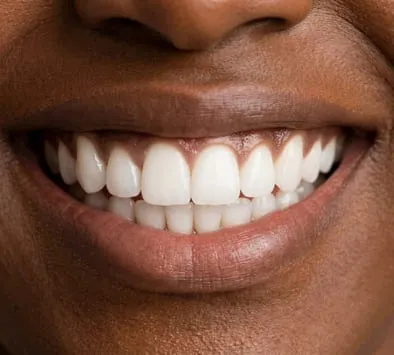Smile after makeover at Garden Family Dental Centre