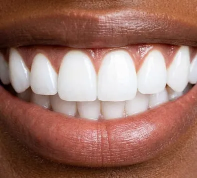 Teeth after braces and aligners treatment at Garden Family Dental Centre
