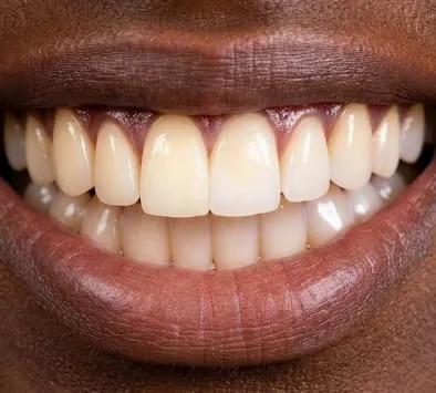 Teeth before whitening treatment at Garden Family Dental Centre
