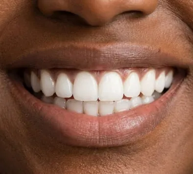 Smile before makeover at Garden Family Dental Centre