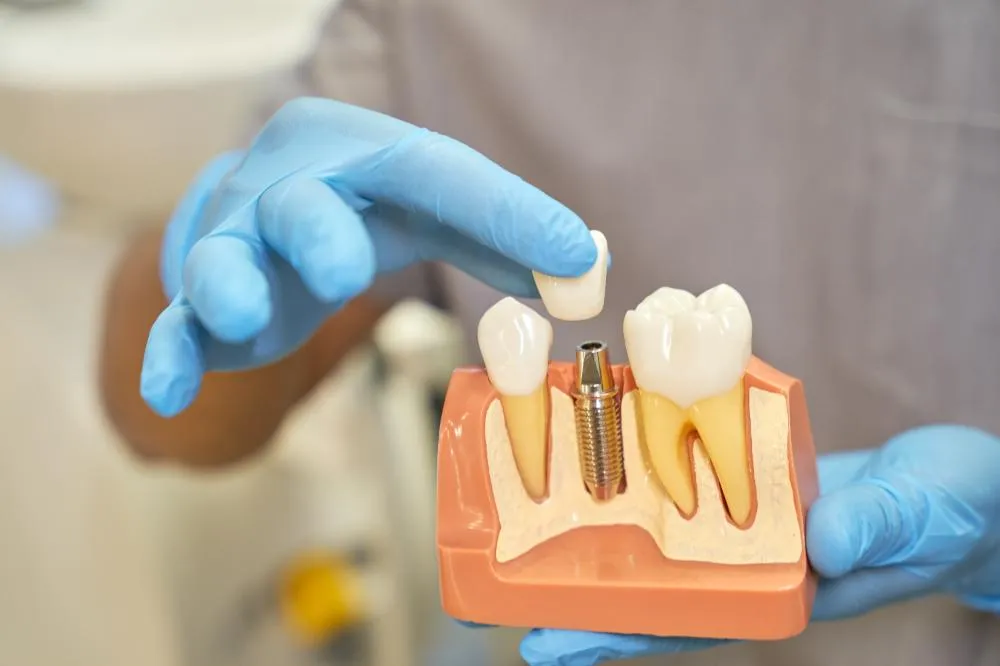 model of a dental implant held by a dentist