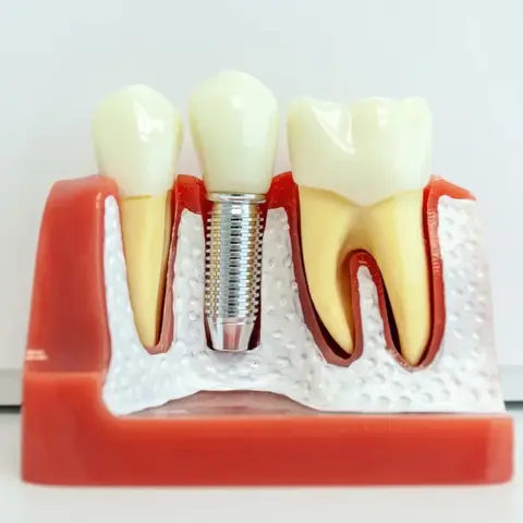 Model of a dental implant showing teeth, gums and bone