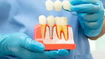 Model of a dental implant rooted into the jaw