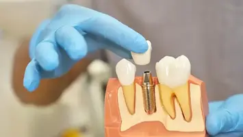 Dentist holding a dental implant model