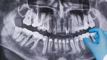 Doctor pointing to braces on a dental x-ray